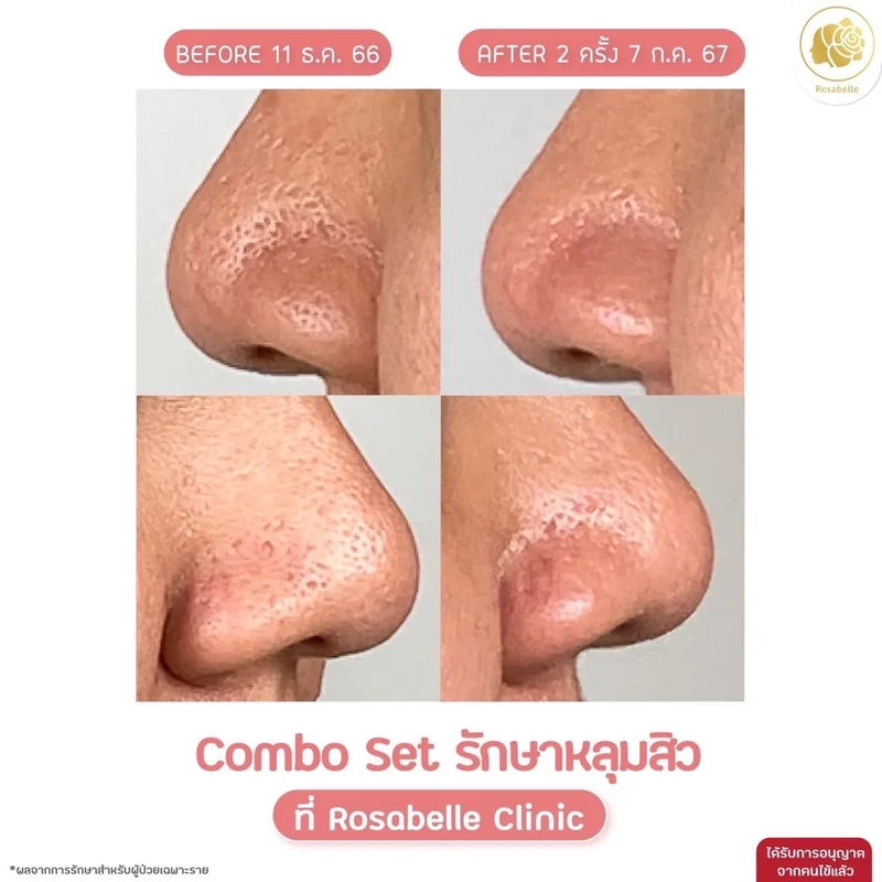 ภาพตัวอย่างรีวิวโปรแกรม Combo Set บริเวณจมูก ก่อนทำ 11 ธ.ค. 2566 หลังทำ 2 ครั้ง 7 ก.ค. 2567