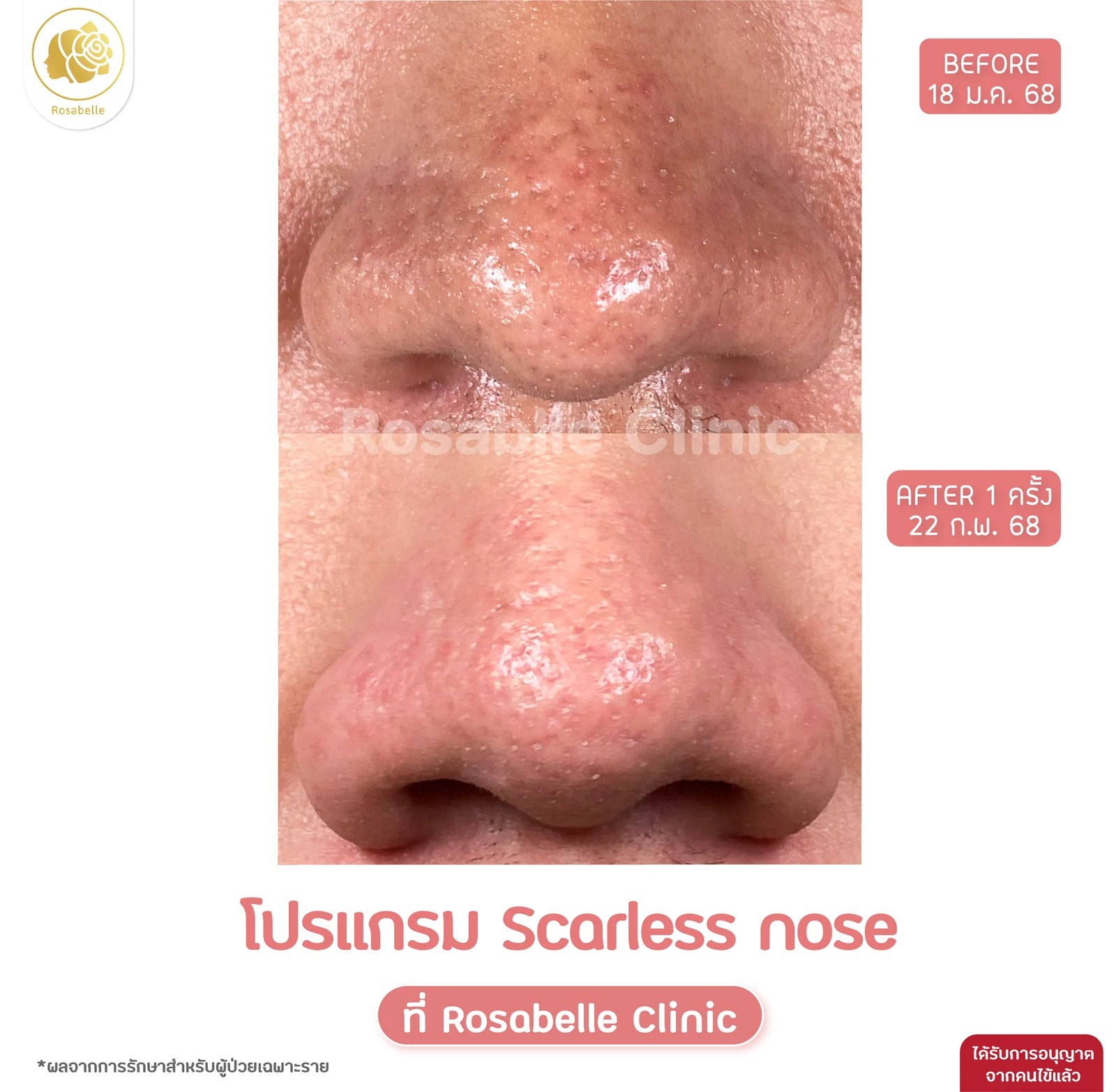 รีวิวโปรแกรม Scarless Nose หลังทำ 1 ครั้ง ก่อนทำ 18 มกราคม 2568 และหลังทำ 22 กุมภาพันธ์ 2568