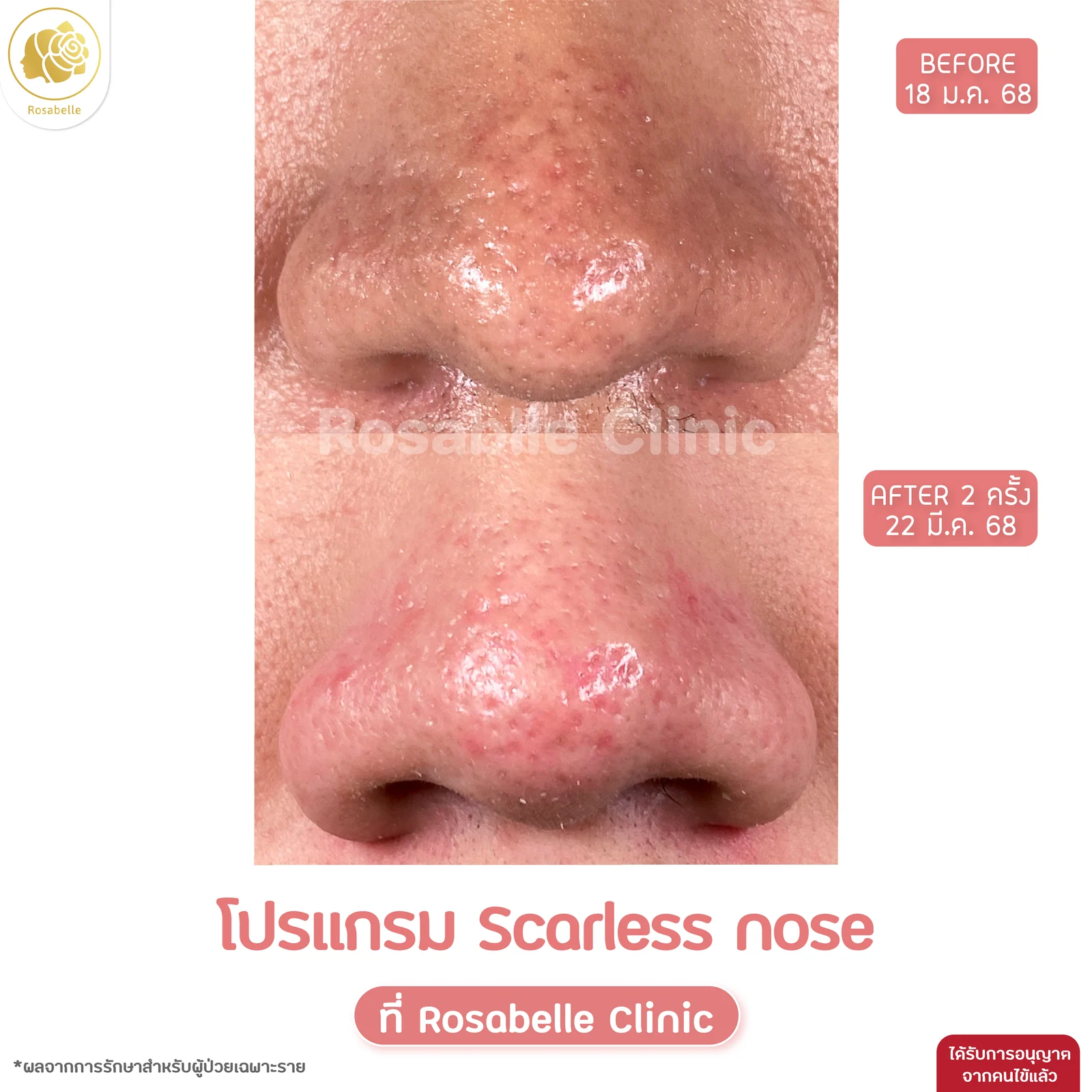 รีวิวโปรแกรม Scarless Nose หลังทำ 2 ครั้ง ก่อนทำ 18 มกราคม 2568 และหลังทำ 22 มีนาคม 2568
